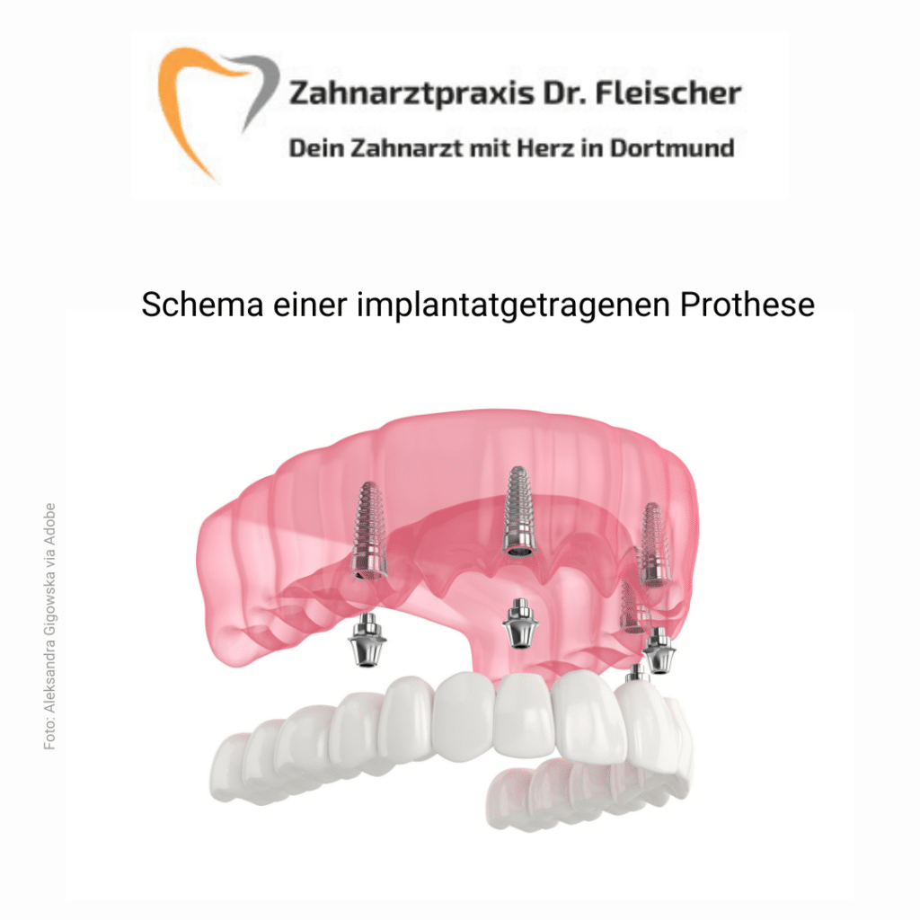 Zahnarztpraxis Dr. Fleischer, Dein Zahnarzt mit Herz in Dortmund, Schema einer implantatgetragenen  Prothese, Foto Aleksandra Gigowska	via Adobe