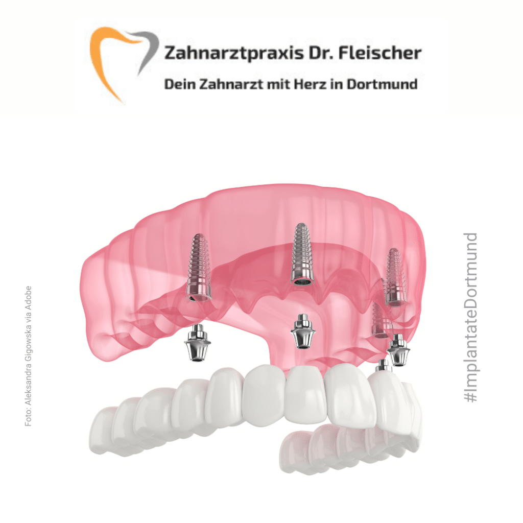 Zahnarztpraxis Fleischer Dein Zahnarzt mit Herz in Dortmund #ImplantateDortmund, Das Bild zeigt eine schematische Darstellung von 4 Implantaten mit einer Verbindung zum Zahnersatz im Oberkiefer Bild: Aleksandra Gigowska via Adobe